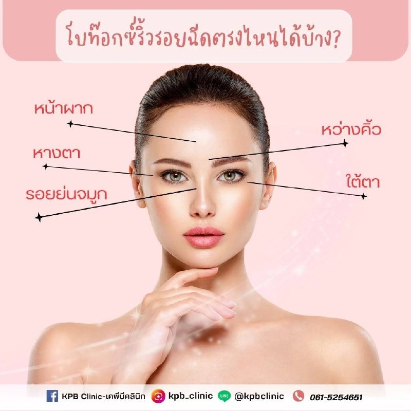 ตำแหน่งโบท็อกซ์ลดริ้วรอย KPB Clinic