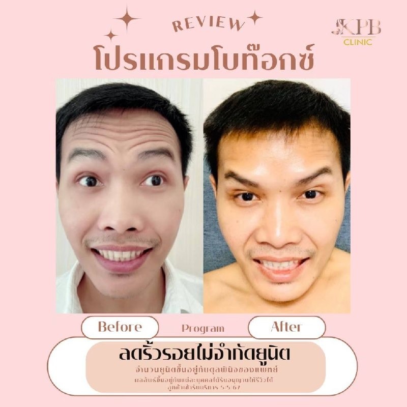 รีวิวโปรแกรมโบท็อกซ์ลดริ้วรอยหน้าผาก KPB Clinic