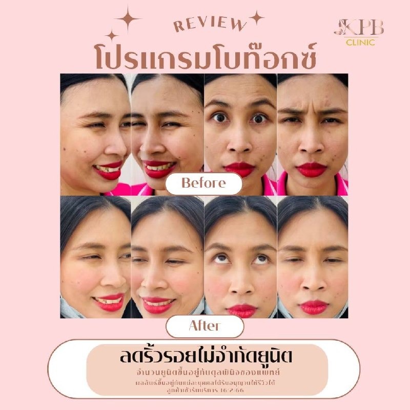 รีวิวโปรแกรมโบท็อกซ์ลดริ้วรอย KPB Clinic