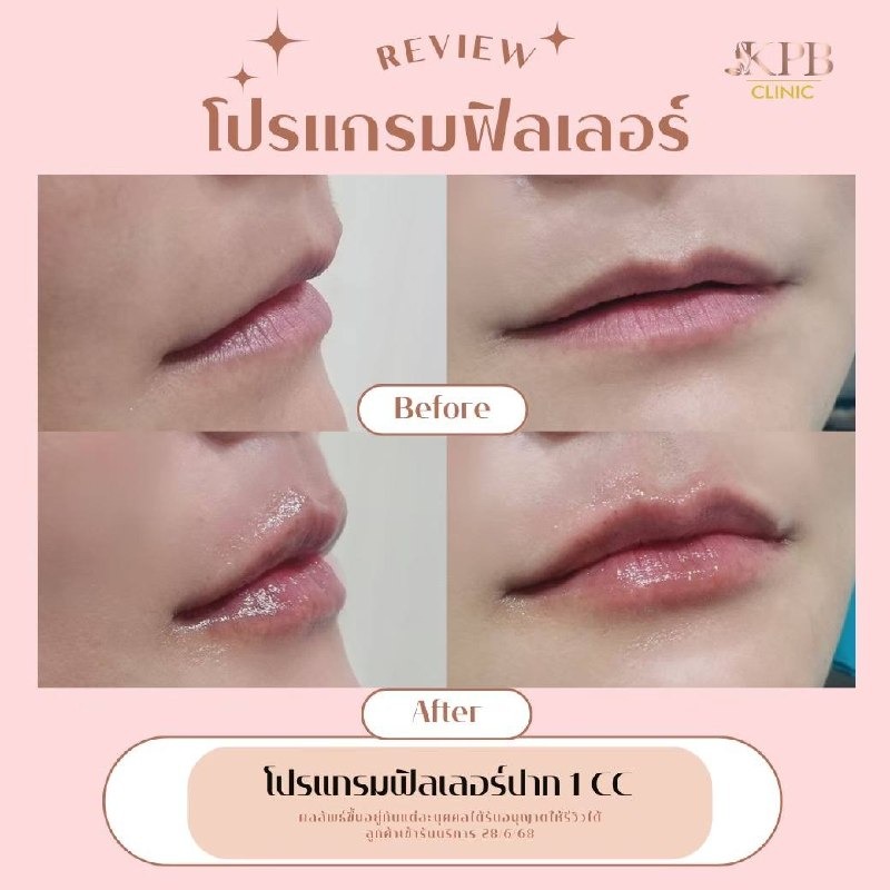 รีวิวโปรแกรมฟิลเลอร์ปาก KPB Clinic ลำดับที่ 2