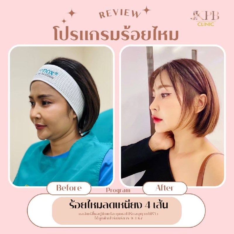 รีวิวโปรแกรมร้อยไหม KPB Clinic ลำดับที่ 8